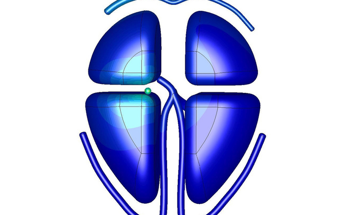 Eine Visualierung der elektrischen Aktivität des Herzens mit fokalen ventrikulären Tachykardien.