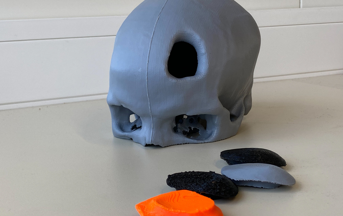 Schädel mit Loch und vier Implantate alles aus dem 3D-Drucker
