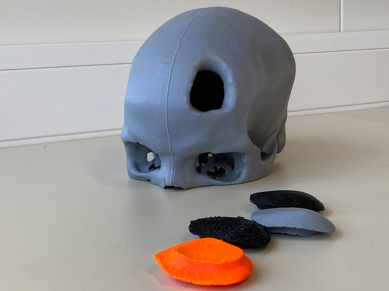 Schädel mit Loch und vier Implantate alles aus dem 3D-Drucker